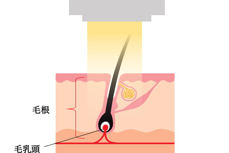 光脱毛(エステ脱毛)